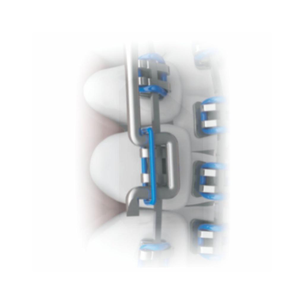 Elastic Ligature Applicator - Plastic_2